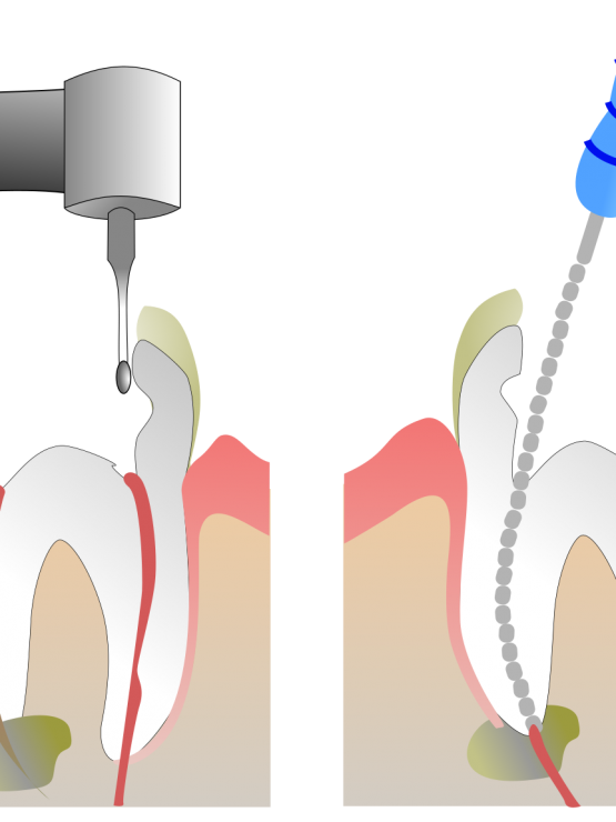 Root Canal Treatment - RCT Specialist in Gurgaon