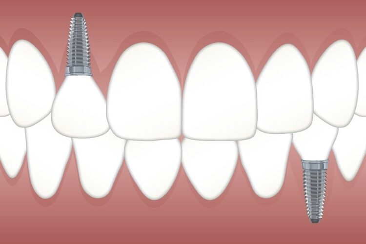 Implant Vs Dentures