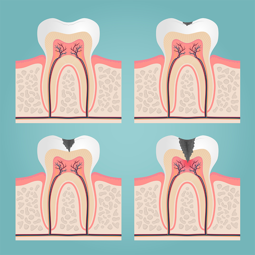 Root canal treatment in Gurgaon – performed by All India Rank 1 Endodontist Dr. Shilpi Gupta at Basil Dental Clinic
