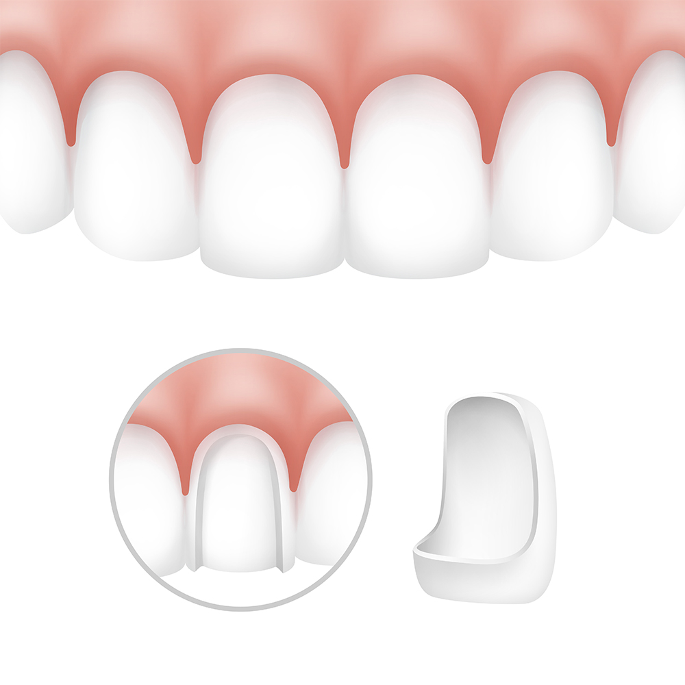 Dental crowns and porcelain veneers in Gurgaon by MDS Prosthodontist at Basil Dental Clinic
