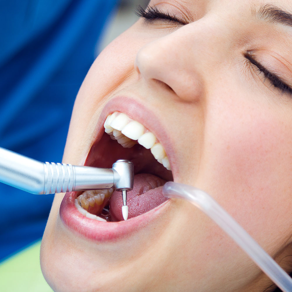 Tooth-coloured composite fillings in Gurgaon – metal-free, natural-looking restorations at Basil Dental Clinic